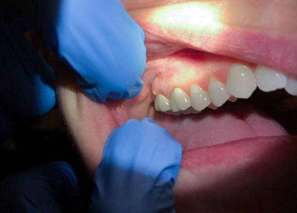 Best Emergency Gum Treatment in Bostonia, CA