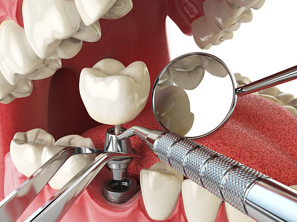 Best Emergency Treatment for Dental Infections or Abscesses in Bostonia, CA